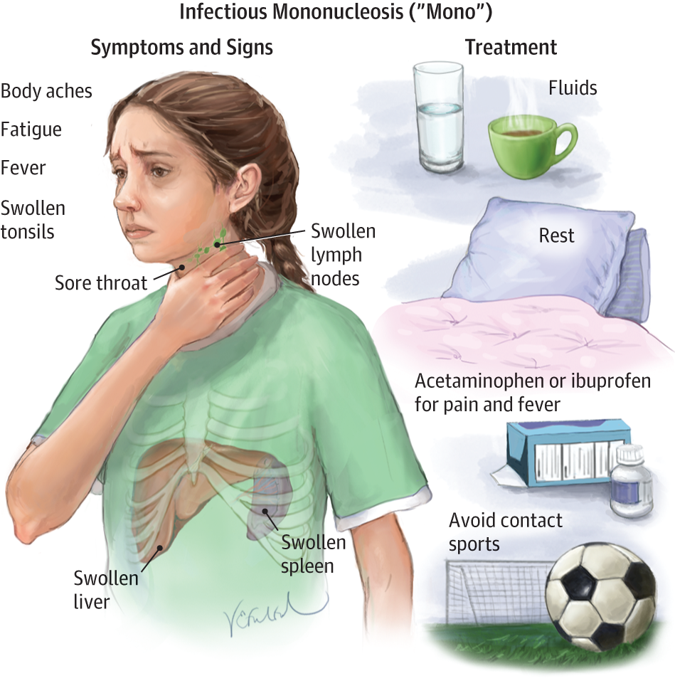 EBV Epstein Barr Virus Mononucleosis MONO NutriMedical