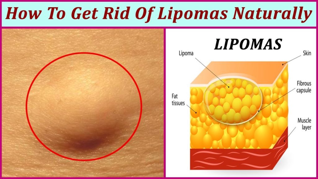 Lipomas Fatty Tumors Nutrimedical