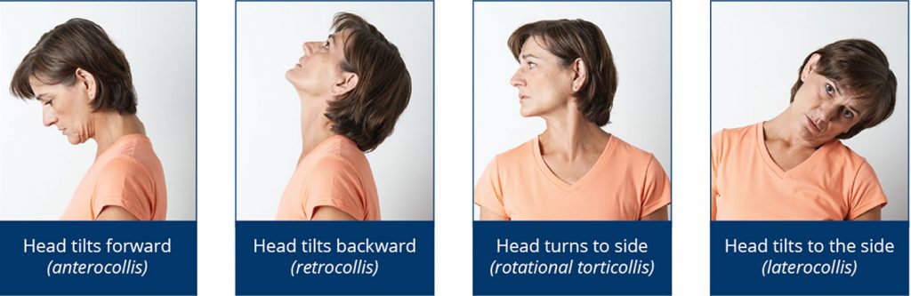 Cervical Dystonia Fibromyalgia Muscle Spasm Recovery Protocols ...